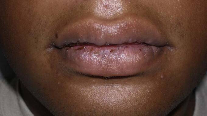 Easy DIY treatments for chapped lips | The ManicaPost