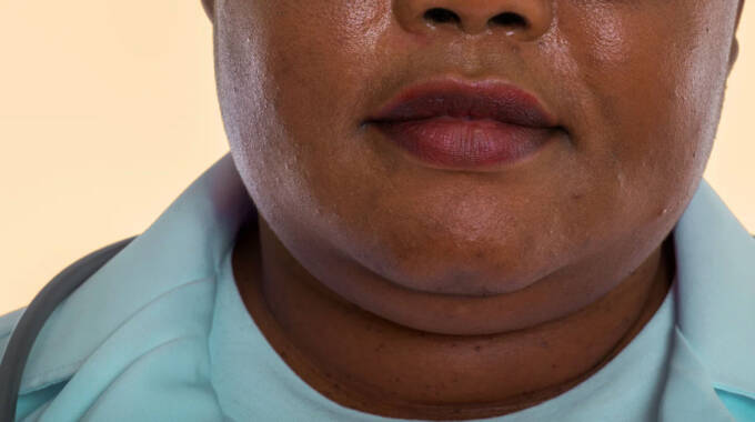 How to get rid of a double chin | The ManicaPost